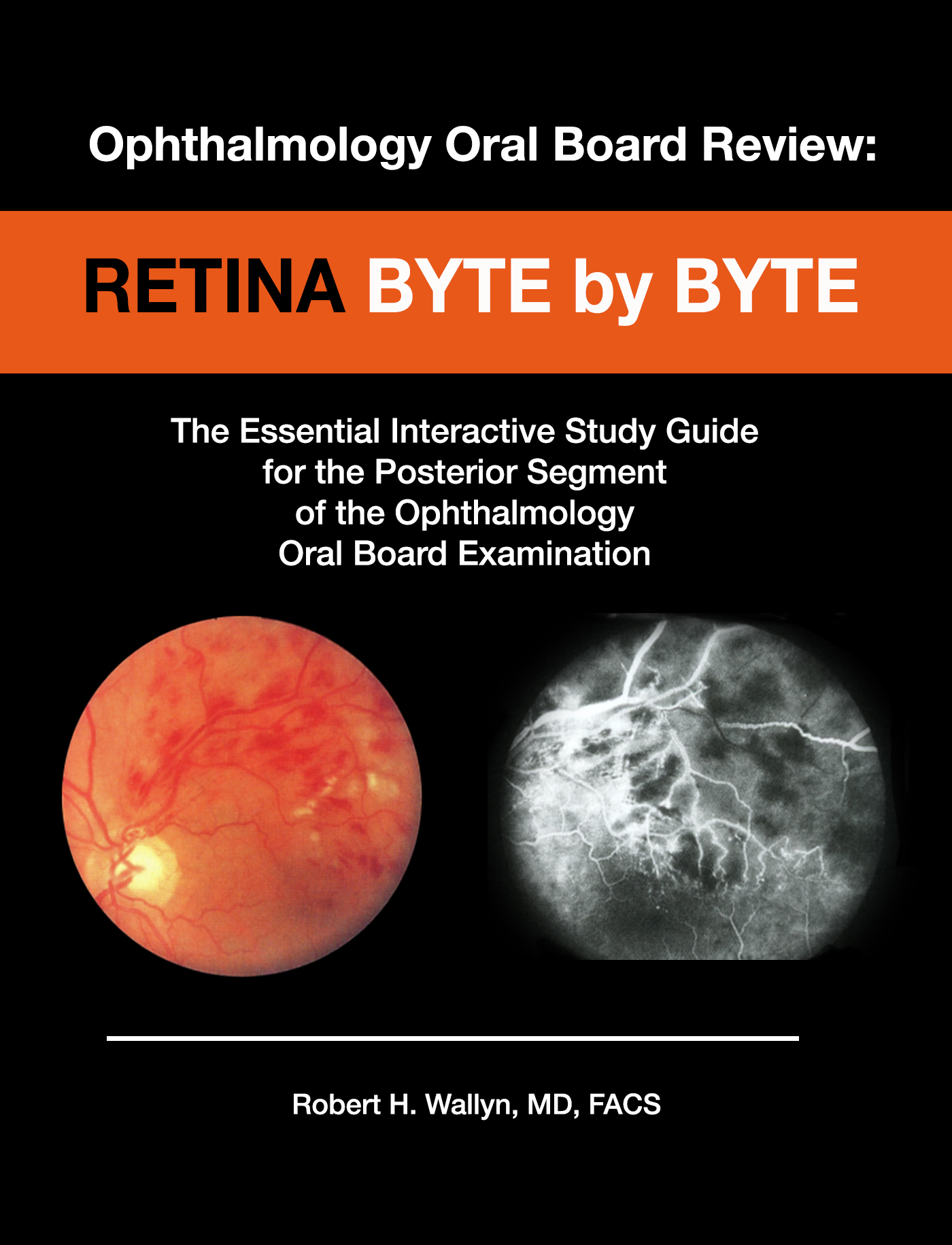 Retina: Byte by Byte Retina: Byte by Byte by Robert H. Wallyn, MD, FACS